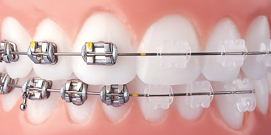 Ortodontik Tedavi | Nokta Ağız ve Diş Sağlığı Polikliniği
